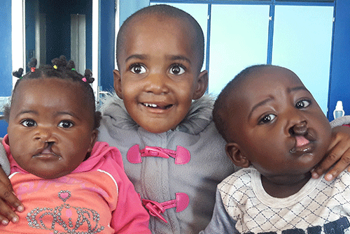 cleft 3 Filling gaps and putting smiles …zooming in on cleft lips, palates