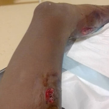 hippo Teen attacked by hippo in Kavango River