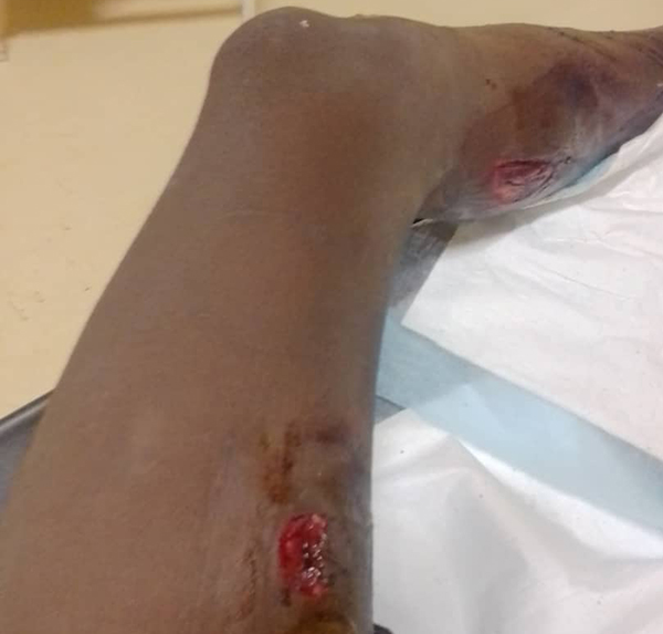 hippo Teen attacked by hippo in Kavango River