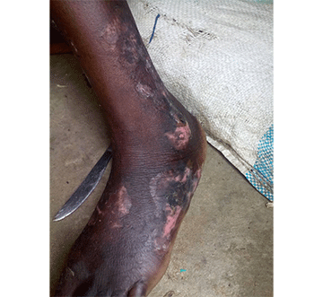 injuries 1 Ash burn victim wants compensation