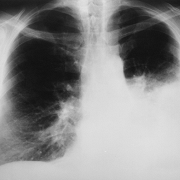 lung 2 Fighting tooth and nail to see another day…a mother’s struggle with lung lupus