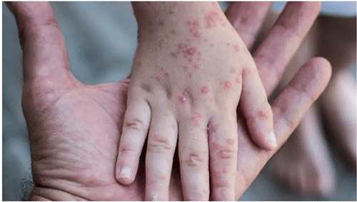 monkey pox Monkeypox: Namibians urged to remain calm