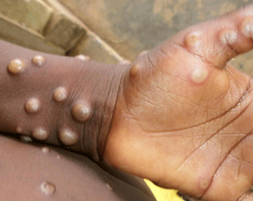 monkeypox 1 Monkeypox declared global health emergency