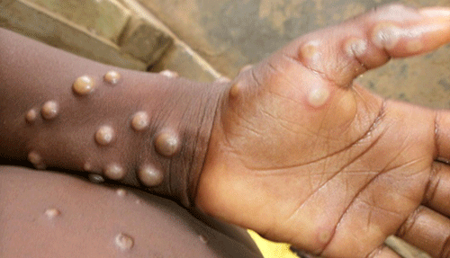 monkeypox 1 Monkeypox declared global health emergency
