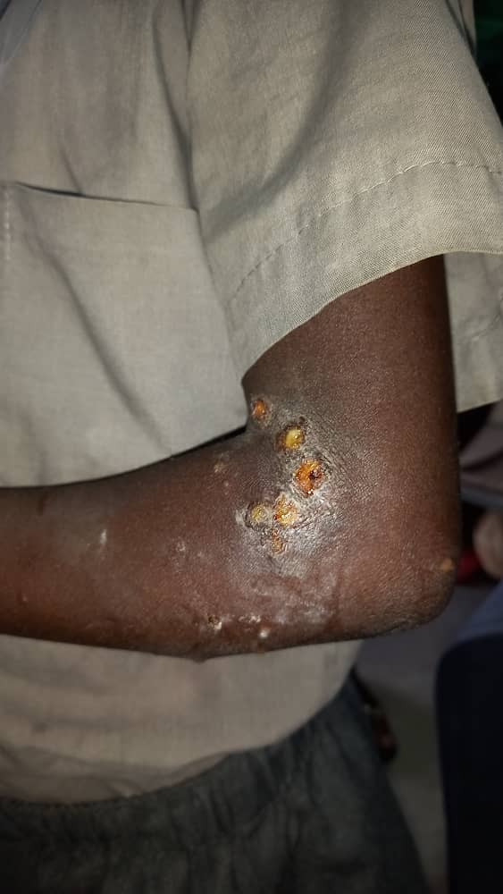 outbreaks Namibia continuously fights disease outbreaks