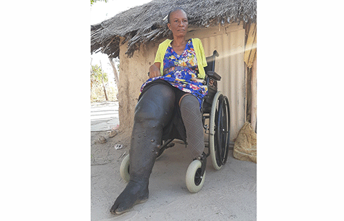 snake bite ‘Onduda oyo nda tungilwa nghi wete handi i nangala’…Omukainhu a lemanekwa komayoka a kanifa omukumo weveluko