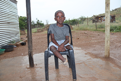 spina bifida Raising a child with spina bifida