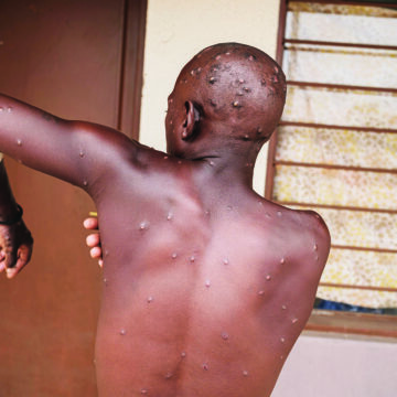 BURUNDI-HEALTH-VIRUS-MPOX Mpox outbreak can be stopped – WHO