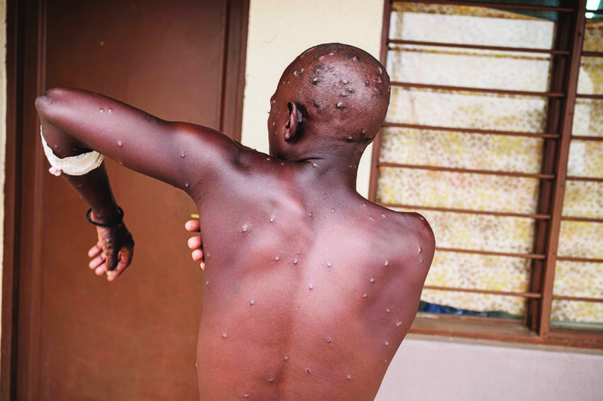 BURUNDI-HEALTH-VIRUS-MPOX Mpox outbreak can be stopped – WHO