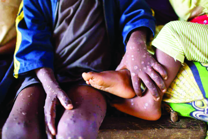 Maladie de la variole du singe (Monkeypox) Mpox declared public health emergency