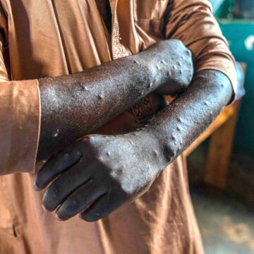 DRCONGO-HEALTH-VIRUS-MPOX Mpox vaccine rollout faces challenges in east DRC